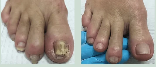 Fungal Nails (2)