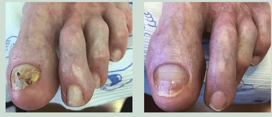 Fungal Nails (3)