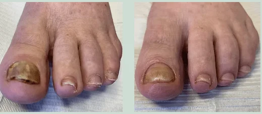 Fungal Nails (4)