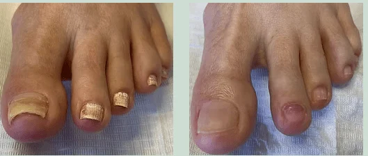 Fungal Nails (5)