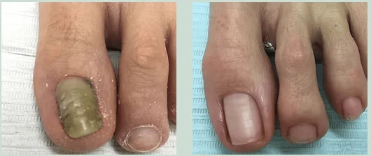 fungal nail treatment in croydon