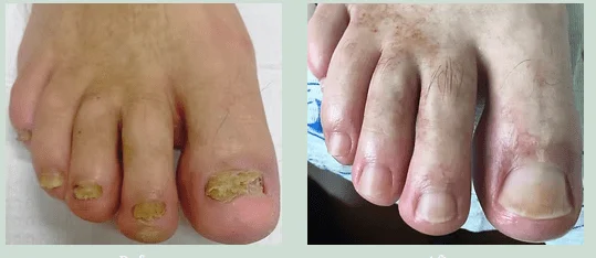 Fungal Nails