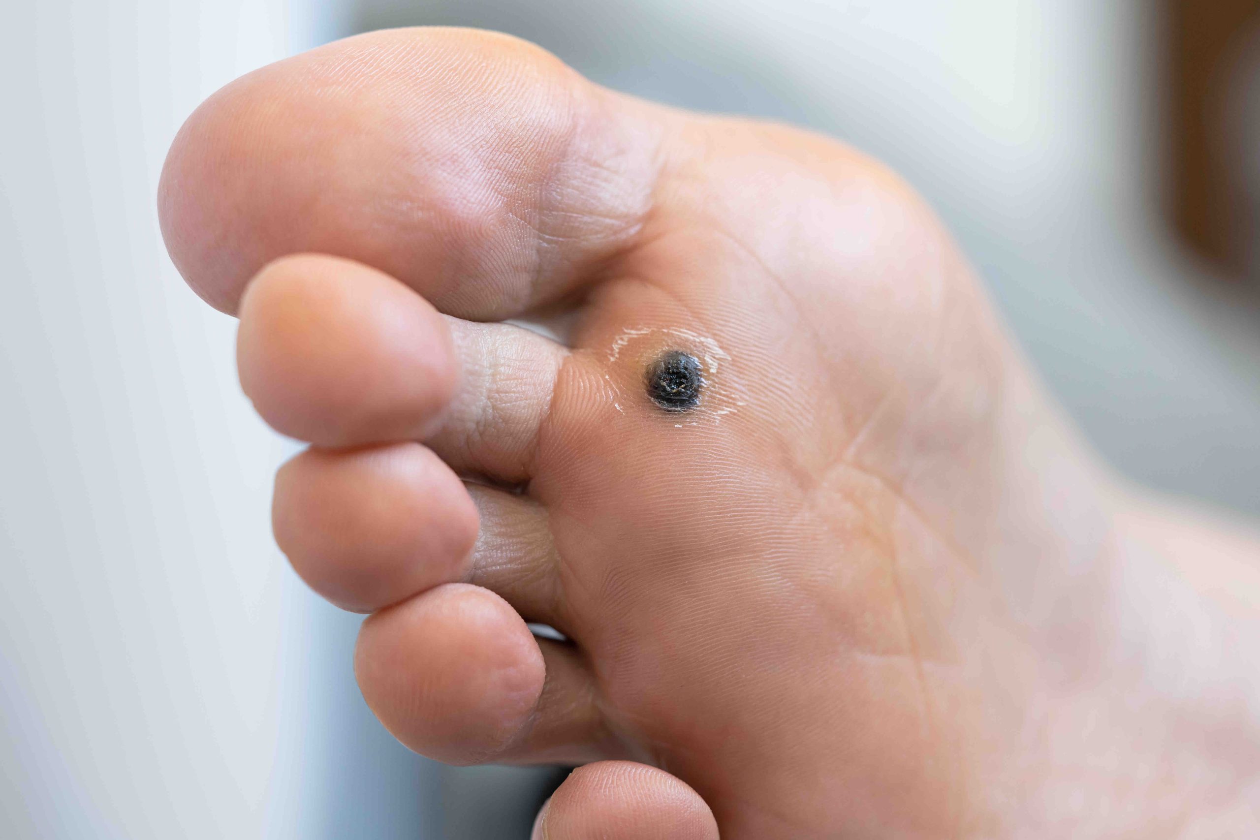 verruca and warts removal - croydon - podiatrist - medi pedicure