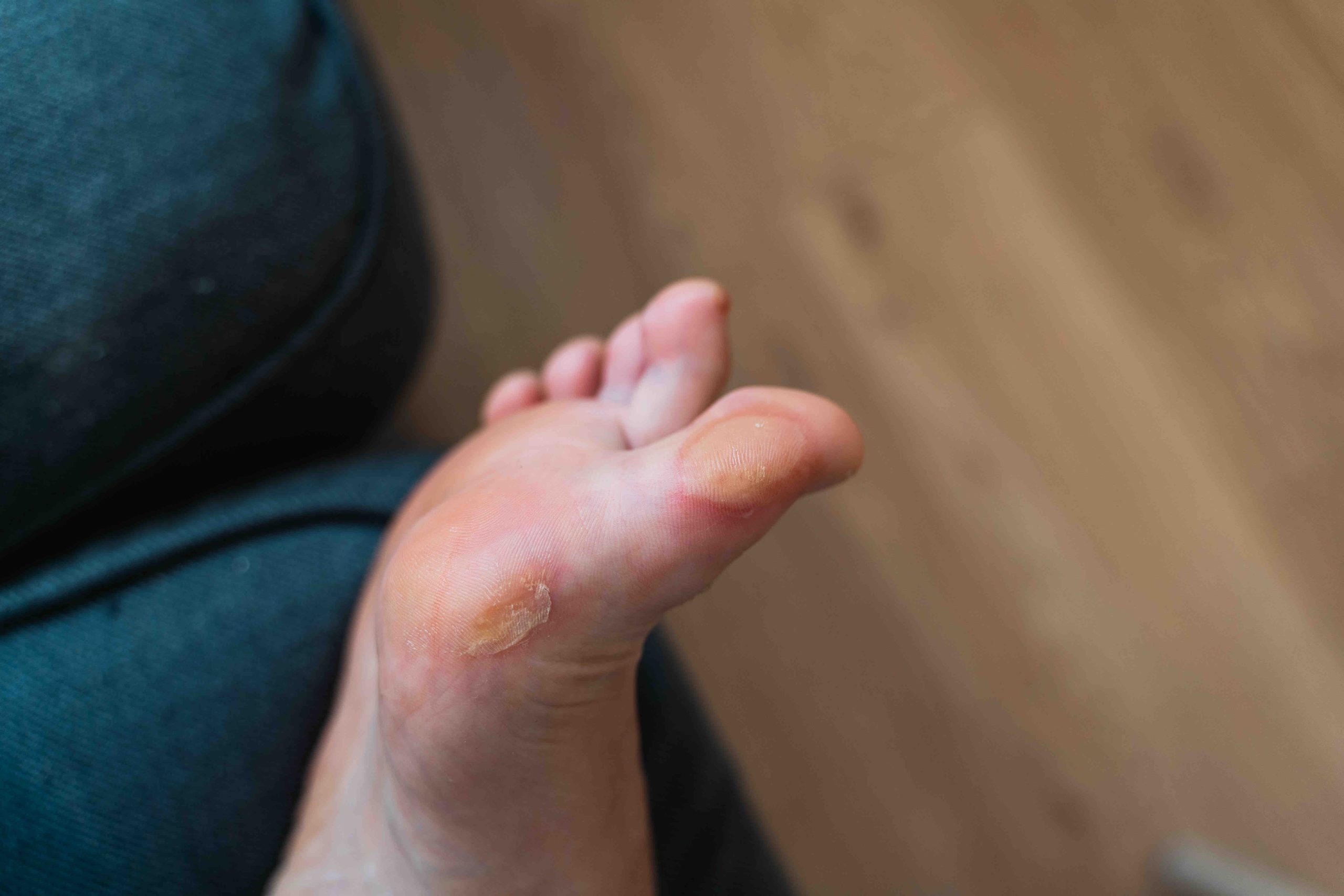 corn and blisters removal treatment in croydon - medical pedicures in croydon - podiatrist